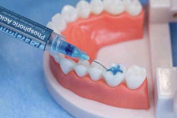 P-Etchant Fosforik Asit Etching Jel