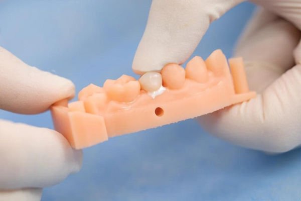 TopCEM - Resin Modifiyeli Cam İyonomer Siman Yapıştırıcı