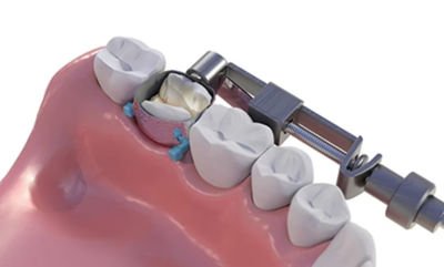Jensen JP-1 Matriks Taşıyıcı Tofflemire Universal